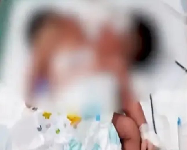 Baby Born with Two Heads in Odisha’s Kandhamal, Receives Specialised Medical Care